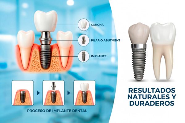 IMPLANTES-pagina-servicios